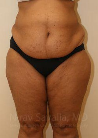 Liposuction Gallery - Patient 1655665 - Image 1