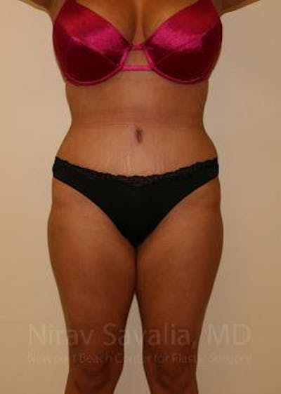 Abdominoplasty / Tummy Tuck Before & After Gallery - Patient 1655666 - Image 2