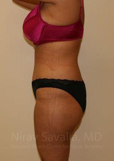Abdominoplasty / Tummy Tuck Before & After Gallery - Patient 1655666 - Image 4
