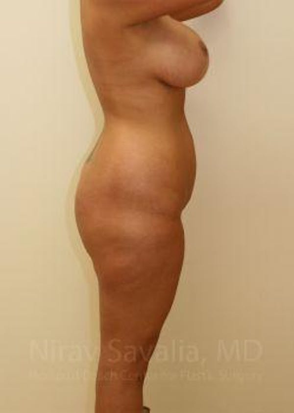Abdominoplasty / Tummy Tuck Before & After Gallery - Patient 1655666 - Image 5