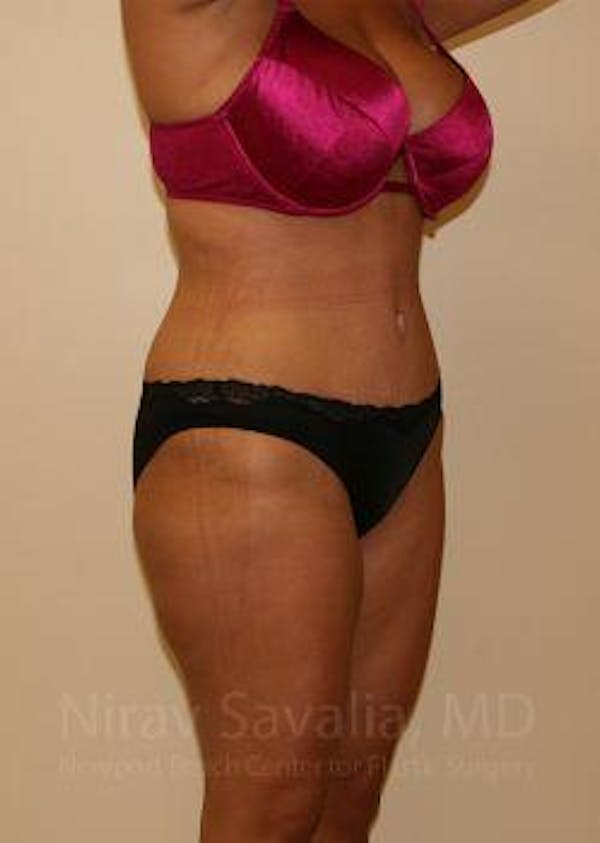Abdominoplasty / Tummy Tuck Before & After Gallery - Patient 1655666 - Image 10