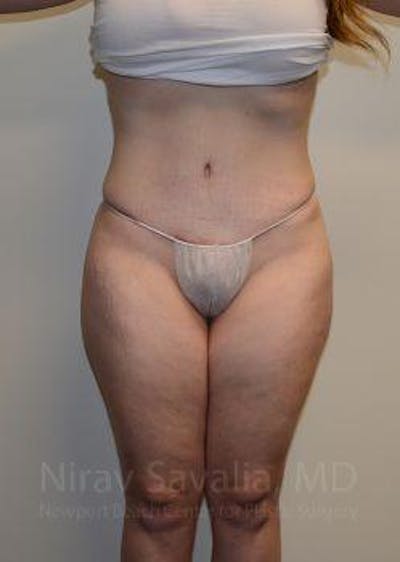 Abdominoplasty / Tummy Tuck Gallery - Patient 1655670 - Image 2