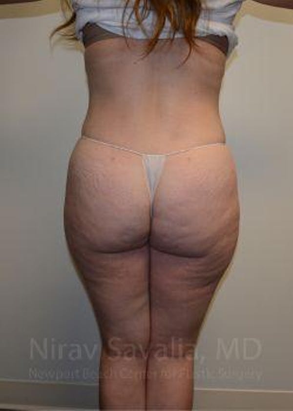 Abdominoplasty / Tummy Tuck Before & After Gallery - Patient 1655670 - Image 4