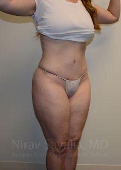 Abdominoplasty / Tummy Tuck Gallery - Patient 1655670 - Image 6