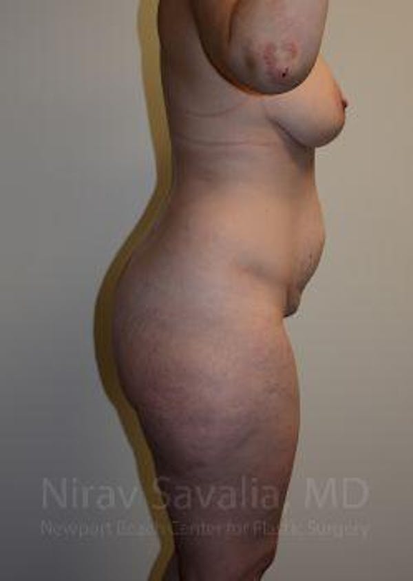Abdominoplasty / Tummy Tuck Gallery - Patient 1655670 - Image 9