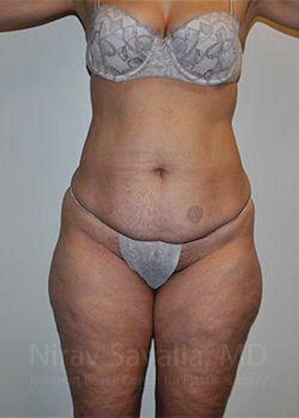 Abdominoplasty / Tummy Tuck Gallery - Patient 1655672 - Image 1