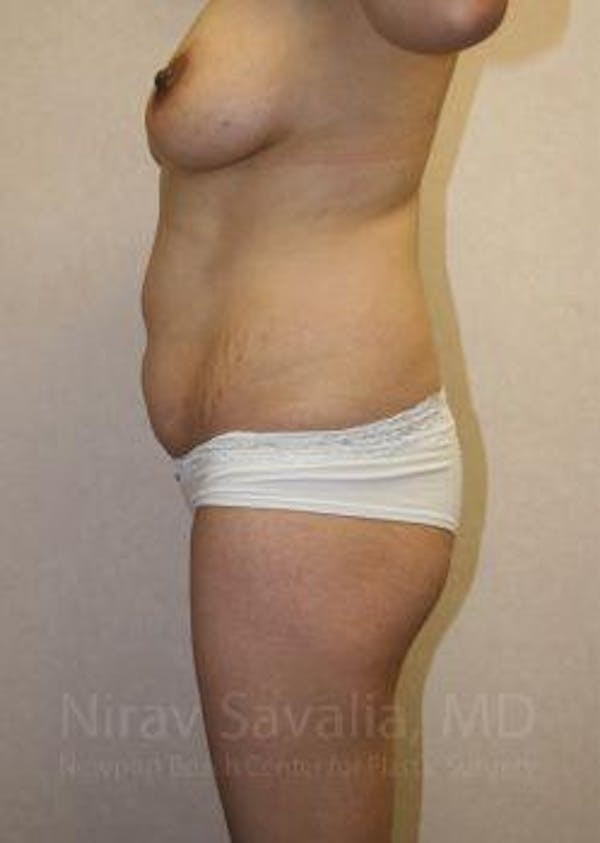 Liposuction Before & After Gallery - Patient 1655671 - Image 5