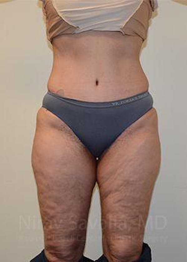 Abdominoplasty / Tummy Tuck Gallery - Patient 1655672 - Image 2