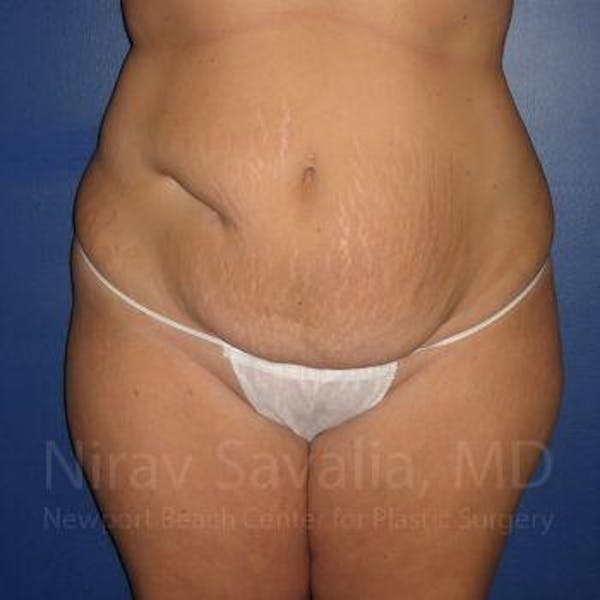 Abdominoplasty / Tummy Tuck Gallery - Patient 1655674 - Image 1
