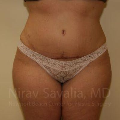 Abdominoplasty / Tummy Tuck Gallery - Patient 1655674 - Image 2