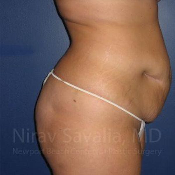 Abdominoplasty / Tummy Tuck Gallery - Patient 1655674 - Image 3