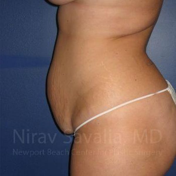 Abdominoplasty / Tummy Tuck Gallery - Patient 1655674 - Image 5