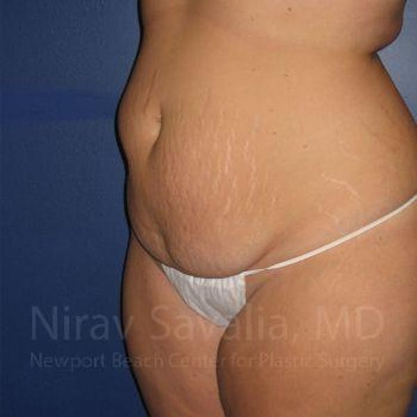 Abdominoplasty / Tummy Tuck Before & After Gallery - Patient 1655674 - Image 7