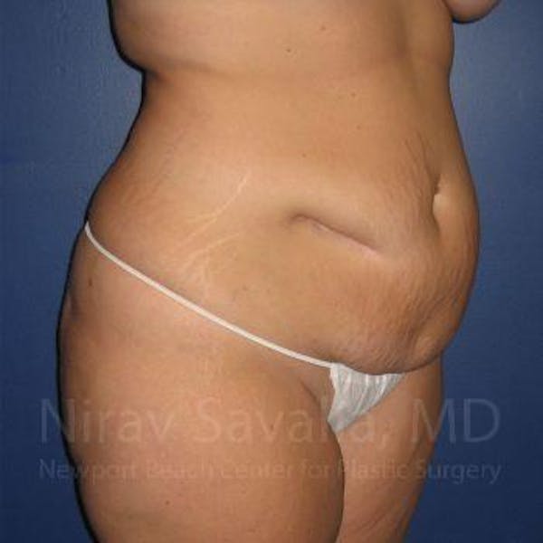 Abdominoplasty / Tummy Tuck Gallery - Patient 1655674 - Image 9