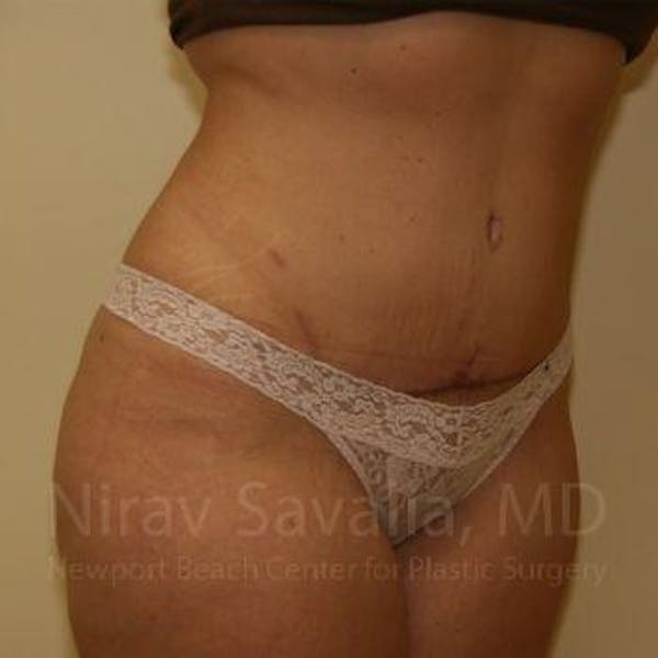 Abdominoplasty / Tummy Tuck Before & After Gallery - Patient 1655674 - Image 10