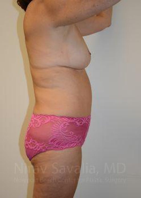 Liposuction Before & After Gallery - Patient 1655676 - Image 8