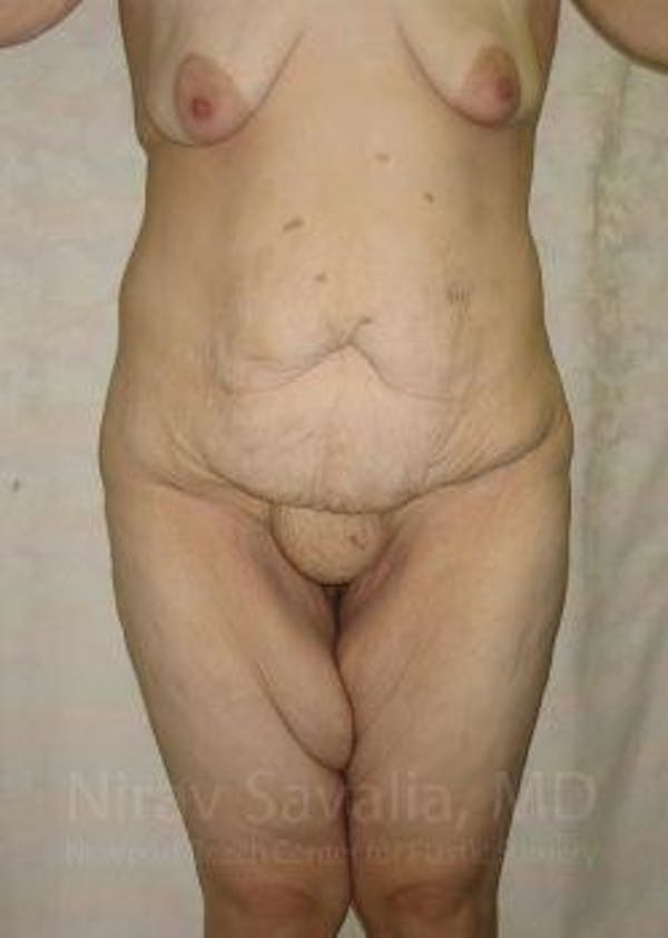 Abdominoplasty / Tummy Tuck Gallery - Patient 1655677 - Image 1