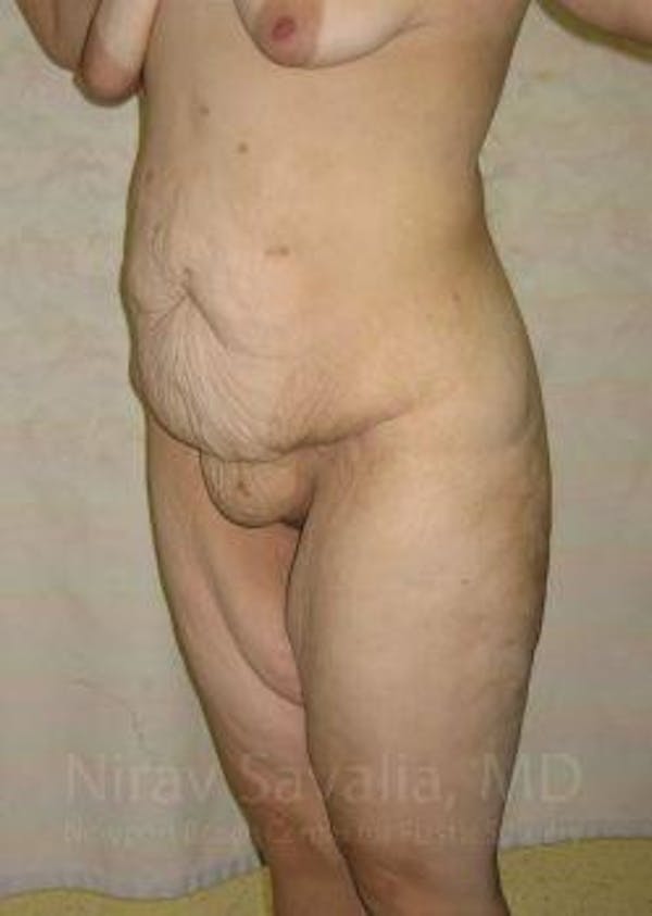 Abdominoplasty / Tummy Tuck Gallery - Patient 1655677 - Image 5