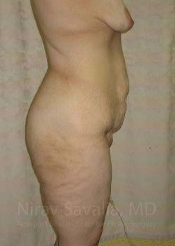 Abdominoplasty / Tummy Tuck Before & After Gallery - Patient 1655677 - Image 7