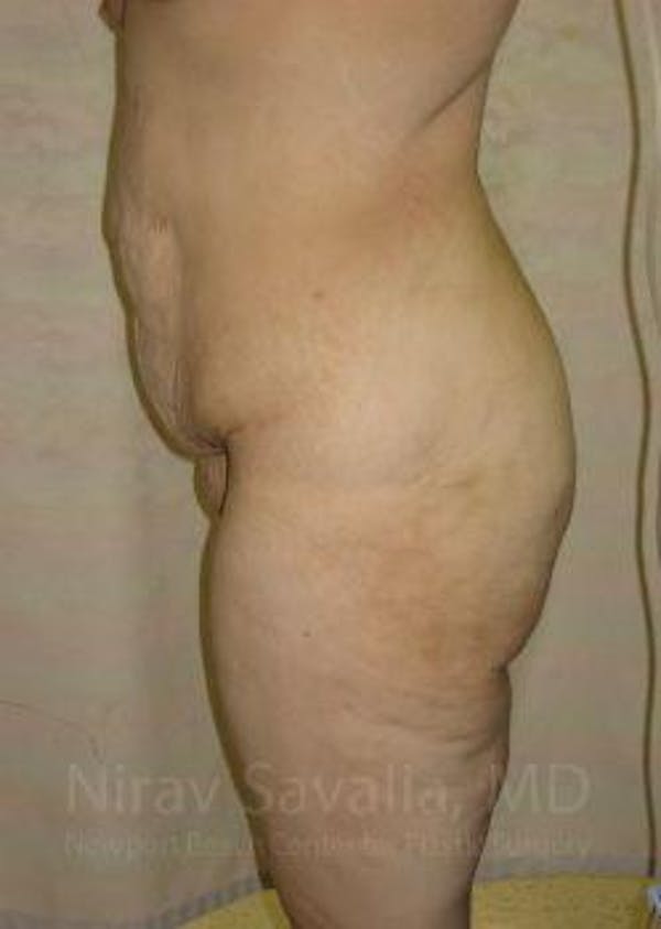 Abdominoplasty / Tummy Tuck Before & After Gallery - Patient 1655677 - Image 9