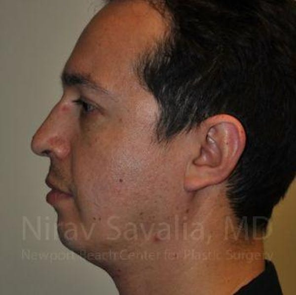 Chin Implants Gallery - Patient 1655678 - Image 1