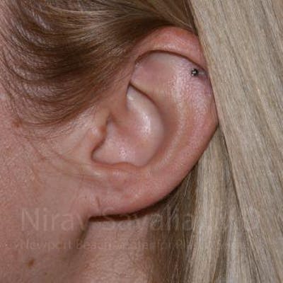 Torn Earlobe Repair / Ear Gauge Repair Before & After Gallery - Patient 1655679 - Image 1