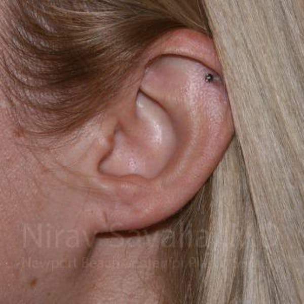 Torn Earlobe Repair / Ear Gauge Repair Before & After Gallery - Patient 1655679 - Image 1