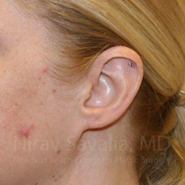 Torn Earlobe Repair / Ear Gauge Repair Before & After Gallery - Patient 1655679 - Image 2
