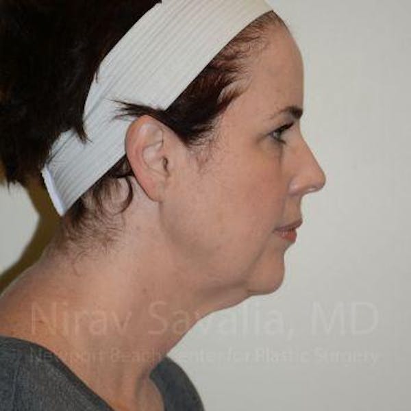 Eyelid Surgery Gallery - Patient 1655683 - Image 3