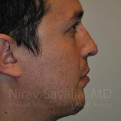 Chin Implants Before & After Gallery - Patient 1655678 - Image 4