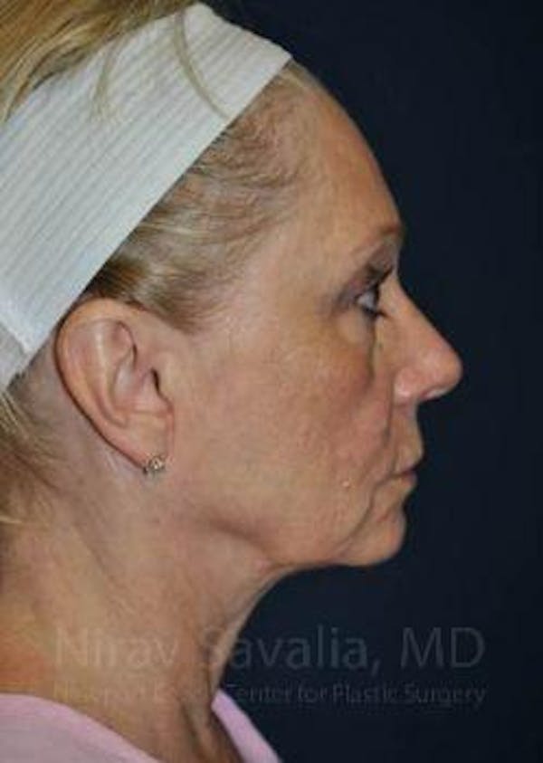 Fat Grafting to Face Before & After Gallery - Patient 1655681 - Image 3