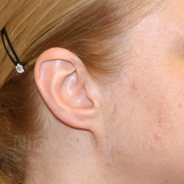 Torn Earlobe Repair / Ear Gauge Repair Before & After Gallery - Patient 1655679 - Image 4