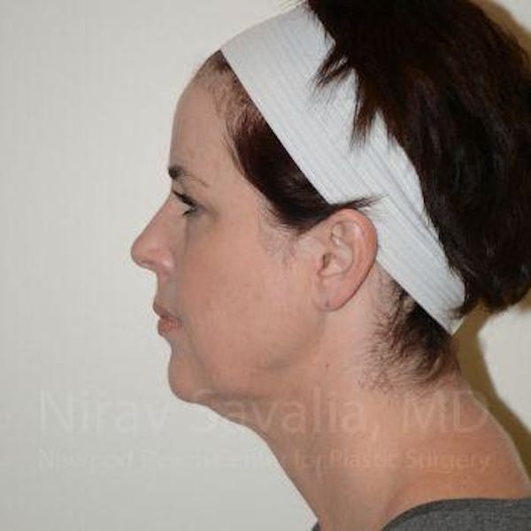 Eyelid Surgery Before & After Gallery - Patient 1655683 - Image 5