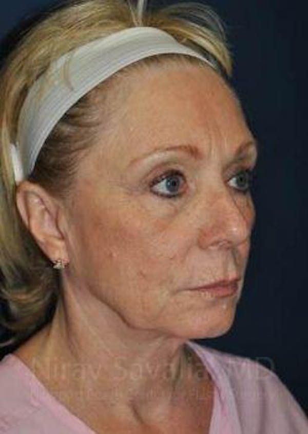 Fat Grafting to Face Before & After Gallery - Patient 1655681 - Image 5