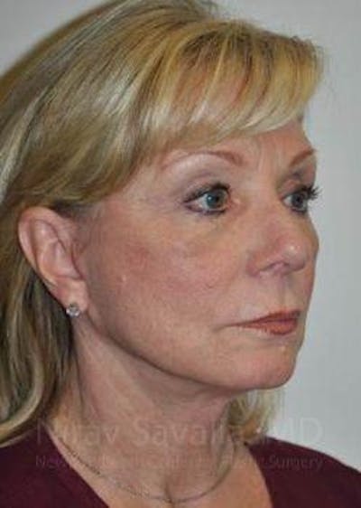 Facelift Before & After Gallery - Patient 1655682 - Image 6
