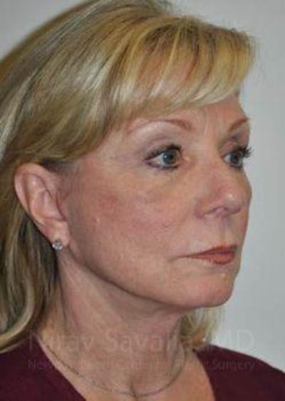 Fat Grafting to Face Before & After Gallery - Patient 1655681 - Image 6