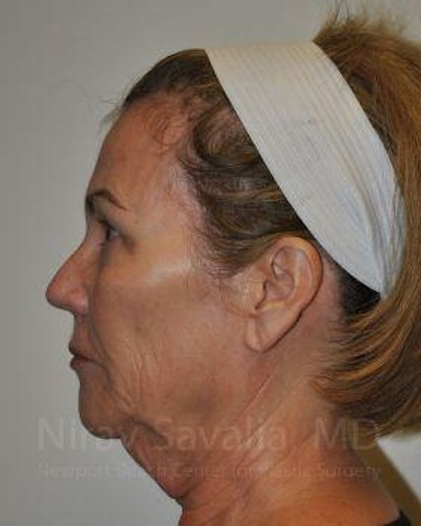 Brow Lift Before & After Gallery - Patient 1655680 - Image 7