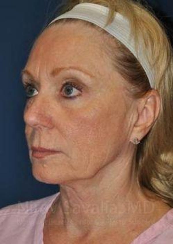 Fat Grafting to Face Before & After Gallery - Patient 1655681 - Image 7
