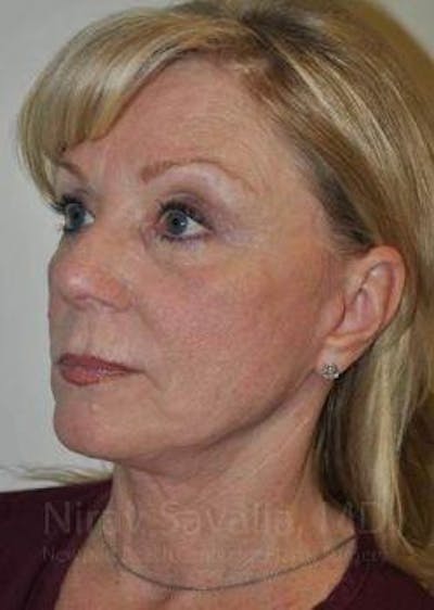 Facelift Before & After Gallery - Patient 1655682 - Image 8