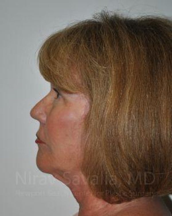 Brow Lift Before & After Gallery - Patient 1655680 - Image 8