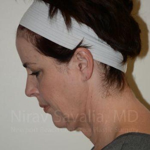 Eyelid Surgery Gallery - Patient 1655683 - Image 9