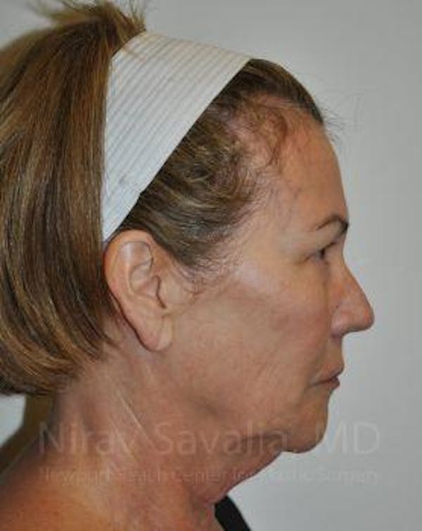 Brow Lift Before & After Gallery - Patient 1655680 - Image 9