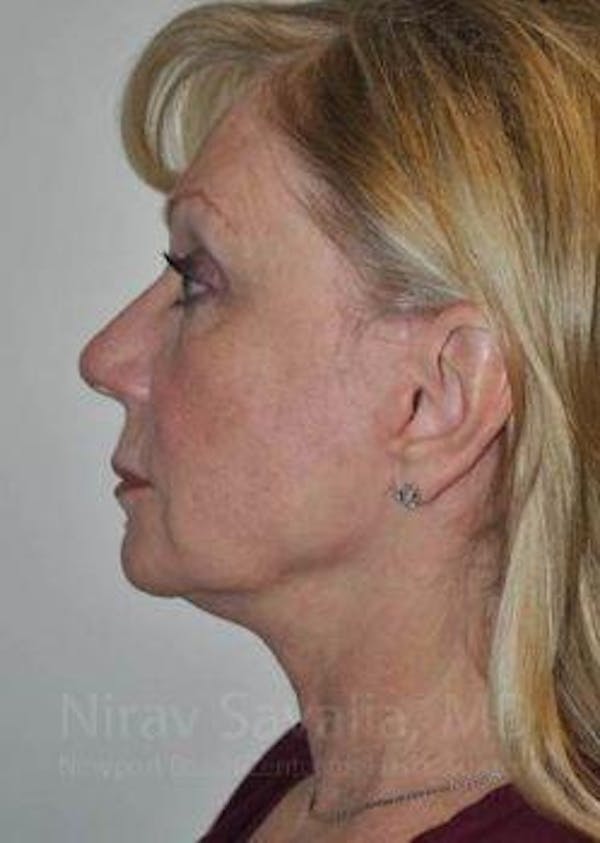 Fat Grafting to Face Gallery - Patient 1655681 - Image 10