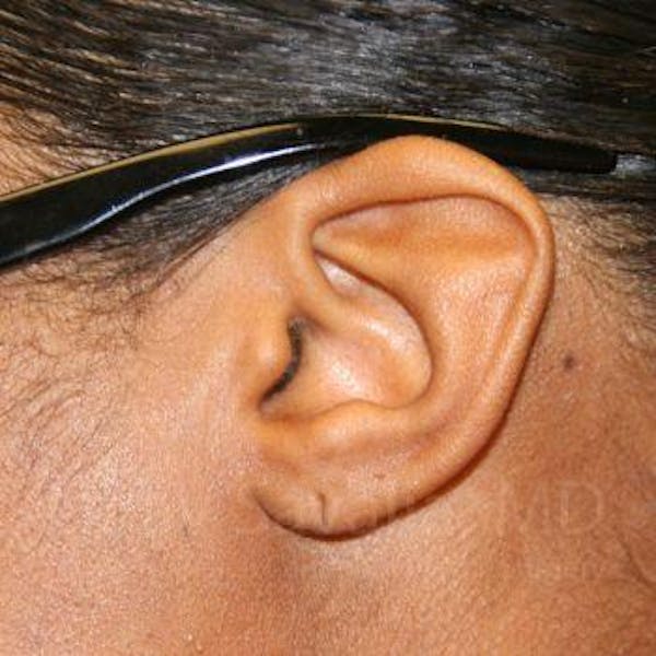 Torn Earlobe Repair / Ear Gauge Repair Before & After Gallery - Patient 1655684 - Image 1