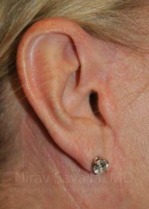 Fat Grafting to Face Before & After Gallery - Patient 1655681 - Image 12