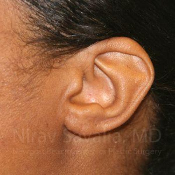 Torn Earlobe Repair / Ear Gauge Repair Before & After Gallery - Patient 1655684 - Image 2