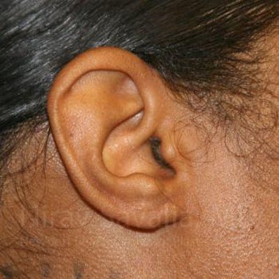 Torn Earlobe Repair / Ear Gauge Repair Before & After Gallery - Patient 1655684 - Image 4