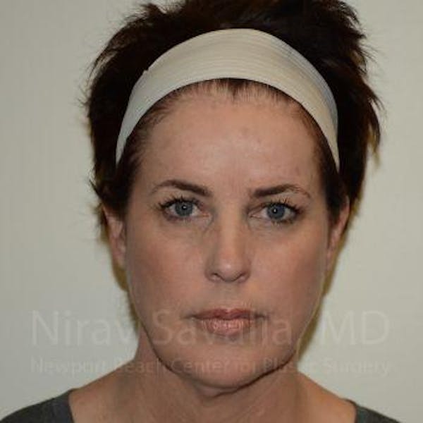 Facelift Before & After Gallery - Patient 1655689 - Image 3
