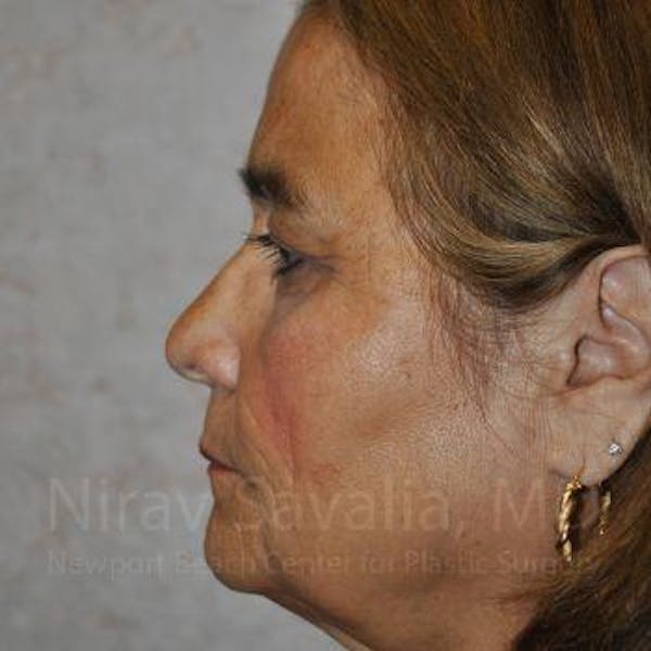 Brow Lift Before & After Gallery - Patient 1655687 - Image 3