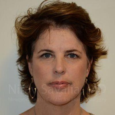 Facelift Before & After Gallery - Patient 1655689 - Image 4